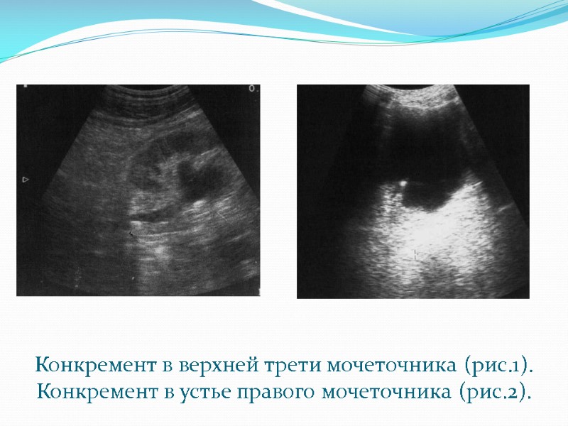 Конкремент в верхней трети мочеточника (рис.1). Конкремент в устье правого мочеточника (рис.2).